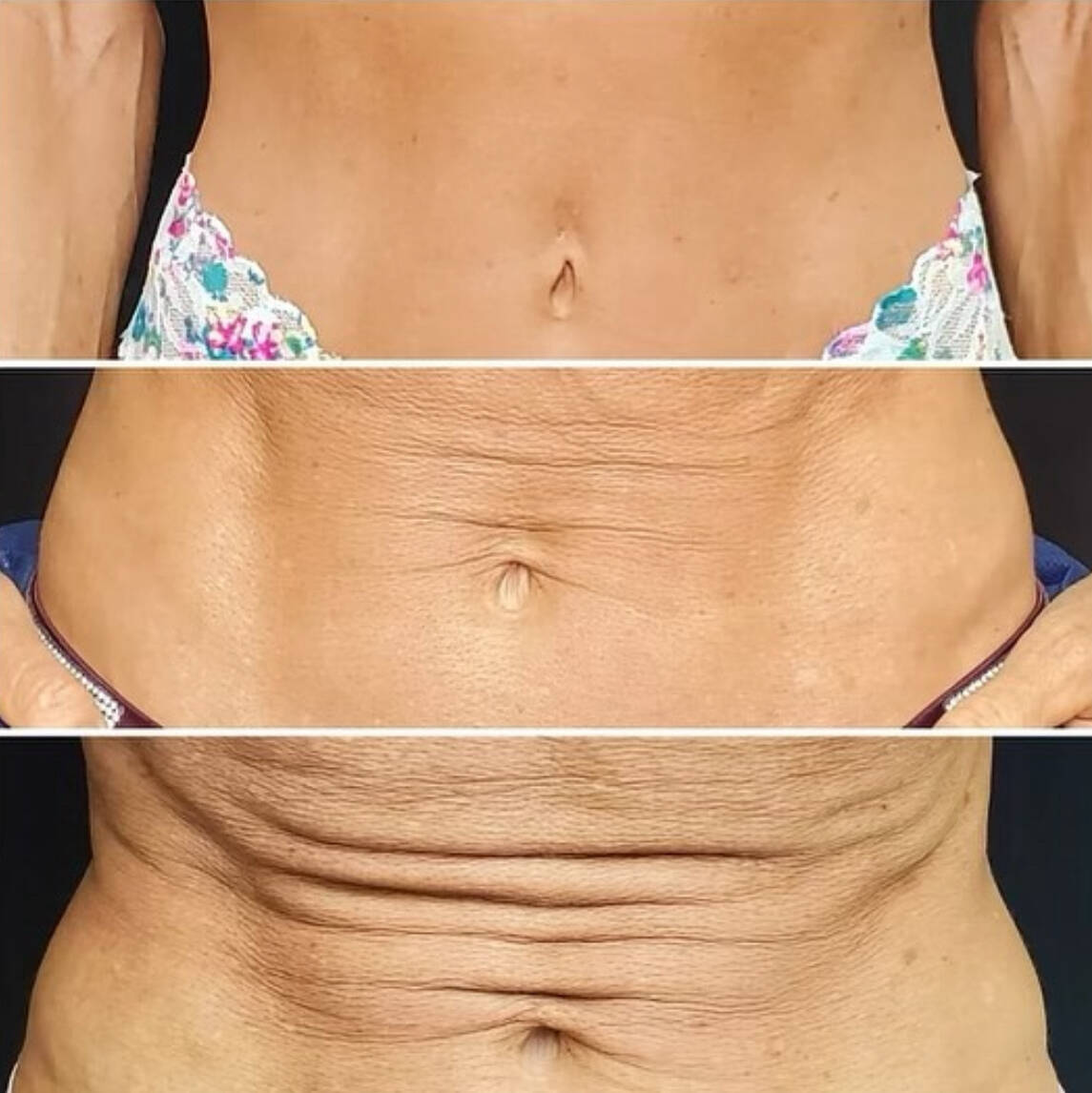 Morpheus8 RF Microneedling (NEW)